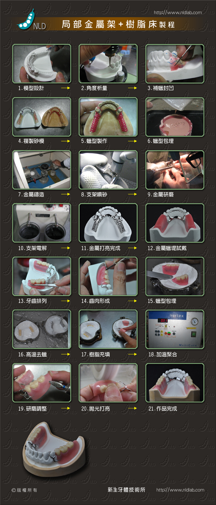 局部活動床 金屬架 局部義齒製作 Erp流程